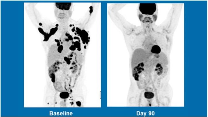 Kite Pharma's experimental CAR-T gene therapy